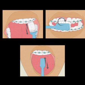 تنظيف تقويم الاسنان
